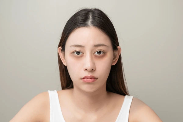 Dark Circles