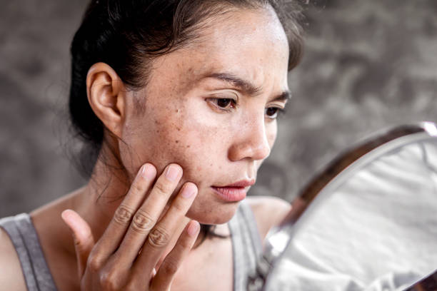 Pimples and Dark Spots