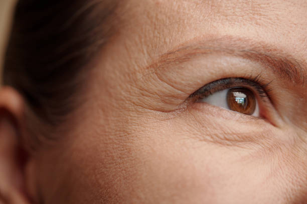 Wrinkles and Freckles