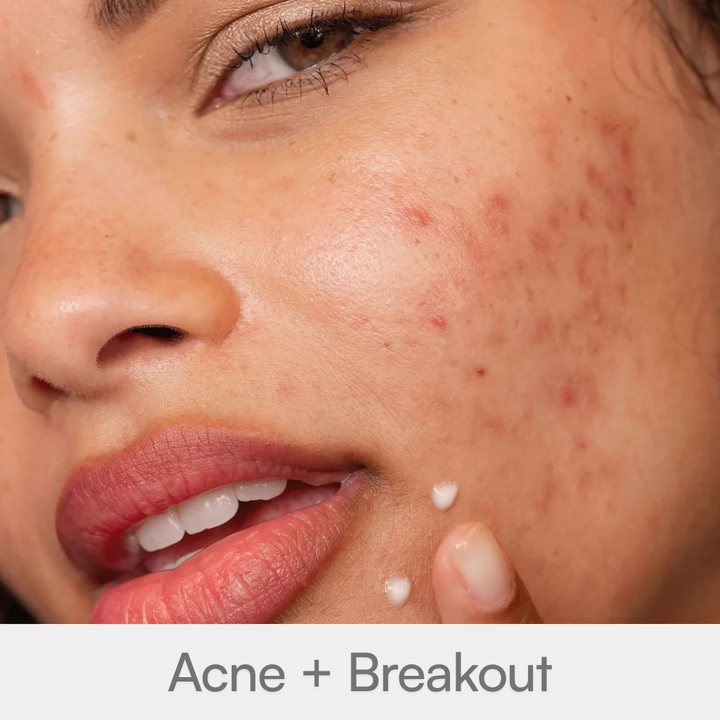 Acne + Breakout
