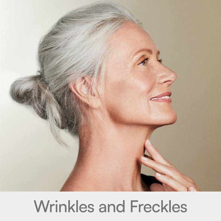 Wrinkles and Freckles