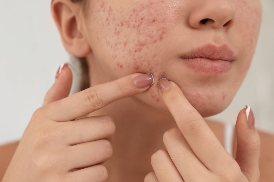 Acne + Breakout