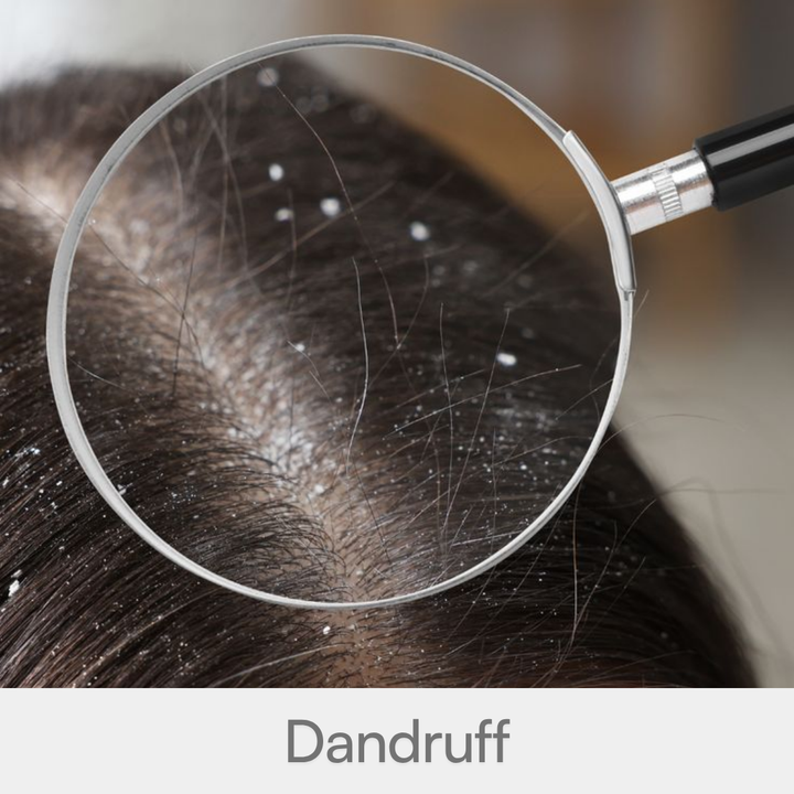 Dandruff